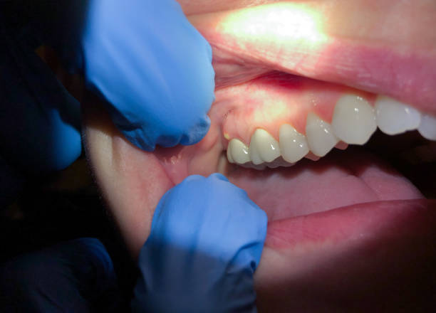 Best Emergency Dental Extractions in Cusseta, GA
